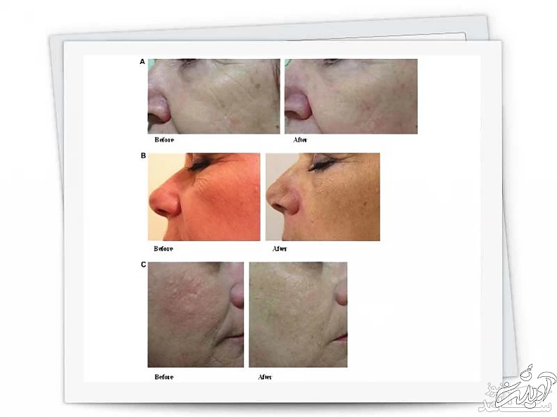 جوانسازی صورت